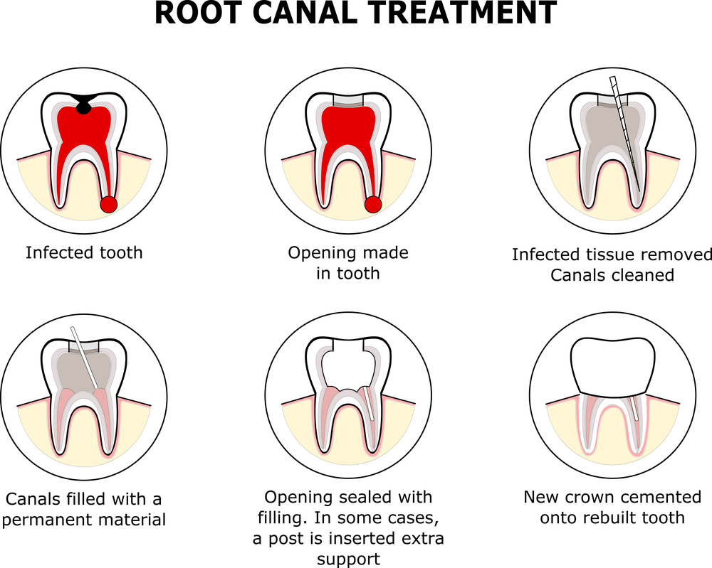 Root Canal Infection Swollen Face